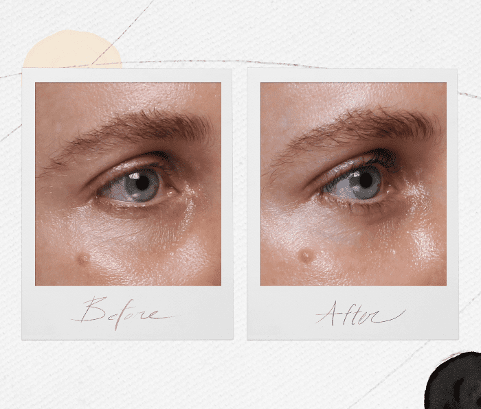 Enchimentos sob os olhos - antes e depois