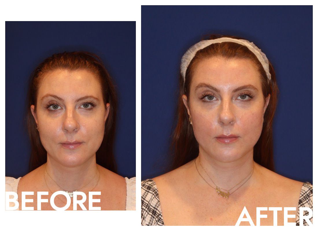 Empse Botox Alternative antes e depois